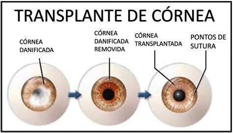 Transplante De Córnea Antes E Depois - Transplante de Córnea - Medicina de Excelência