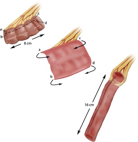 Colovaginoplasty Using The Yang Monti Modification Journal Of