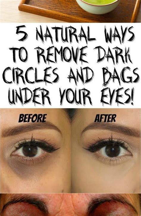 How To Remove Dark Circles Under Eyes At Home Permanently Howtoremvo