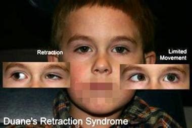 Duane Retraction Syndrome Types