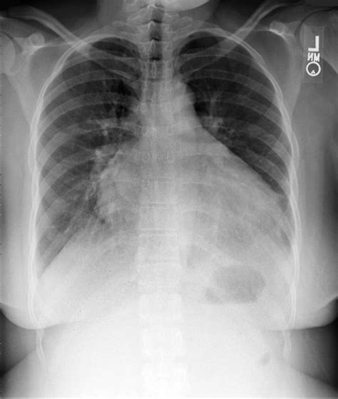 Cardiomegaly Causes