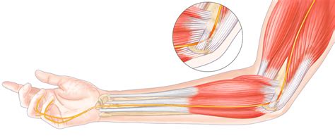 C Compression Du Nerf Ulnaire Au Coude Antoni Sommaire