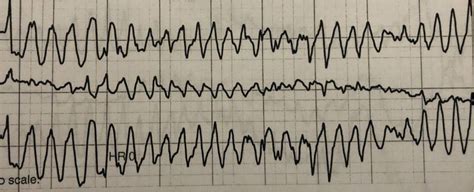 From Dizzy To Torsades De Pointes A Case Report Emra