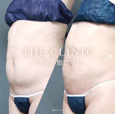 お腹のベイザー脂肪吸引 Theclinic Nagoyaのブログ