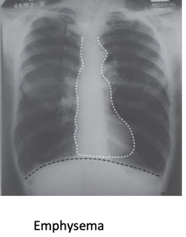 Normal Chest Radiograph Flashcards Quizlet