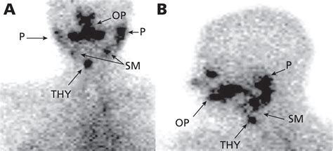 Complications Of Radioactive Iodine Treatment Of Thyroid Carcinoma In