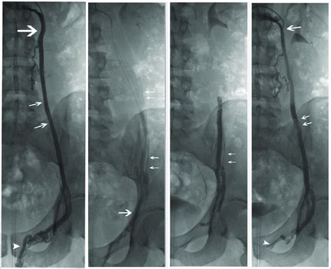 Isv Embolization With Glue Right Selective Venography In Erect