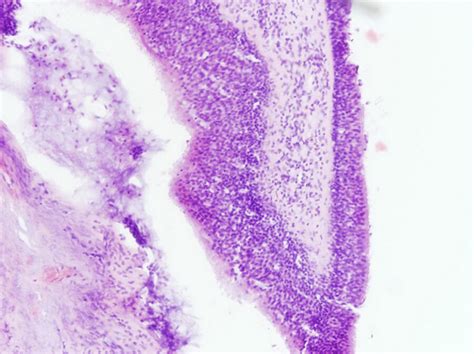 Nasal Polyps Histology