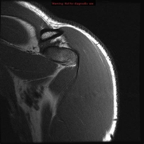 Shoulder Mri Coronal 2 Diagram Quizlet