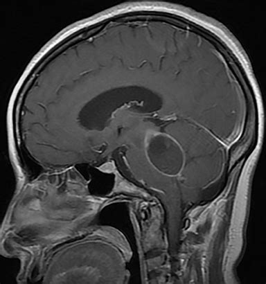 Imaging of hydrocephalus | Applied Radiology