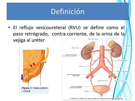 Reflujo Vesico Ureteral Mm Ppt Descarga Gratuita