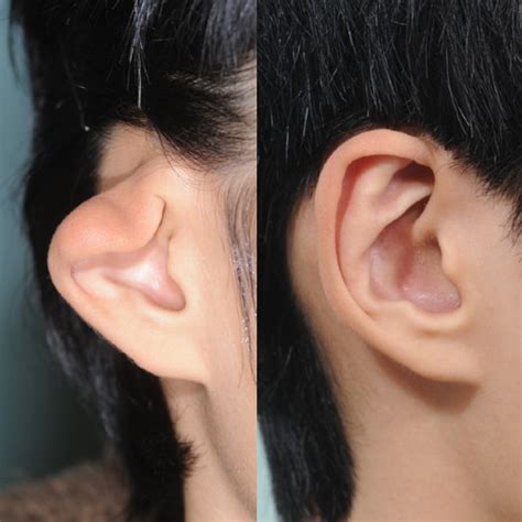 Gallery Ear Surgery Korea Cn