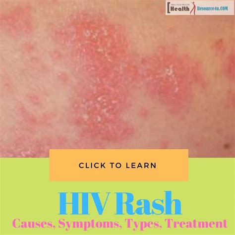 Hiv Skin Rash Symptoms