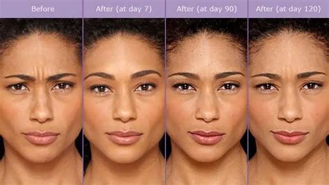 Botox Before After Photos Illume Cosmetic Surgery Medspa