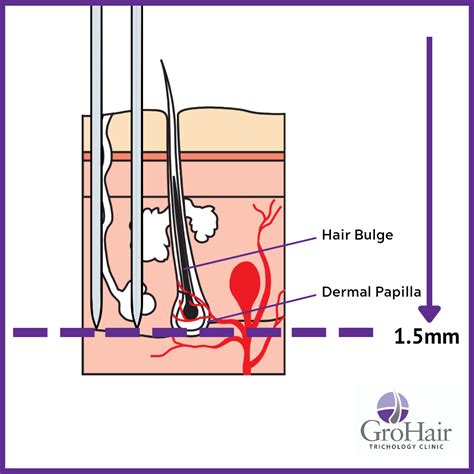 Scalp Microneedling Grohair Trichology Clinic