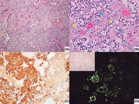 A Low Power View Of Mixed Medullarypapillary Carcinoma On The Right