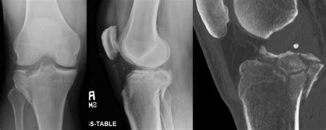 Objective Metric Of Energy Absorbed In Tibial Plateau Fractures