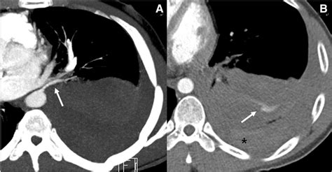 Figure 2 From Transcatheter Embolization For Massive Hemoptysis From An