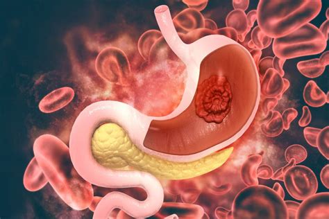 Carcinoma Stomach Dr Masurkar