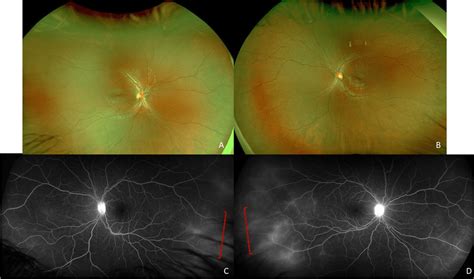 Posterior Segment Imaging Of Both Eyes With Normal Fundus Photos Of The