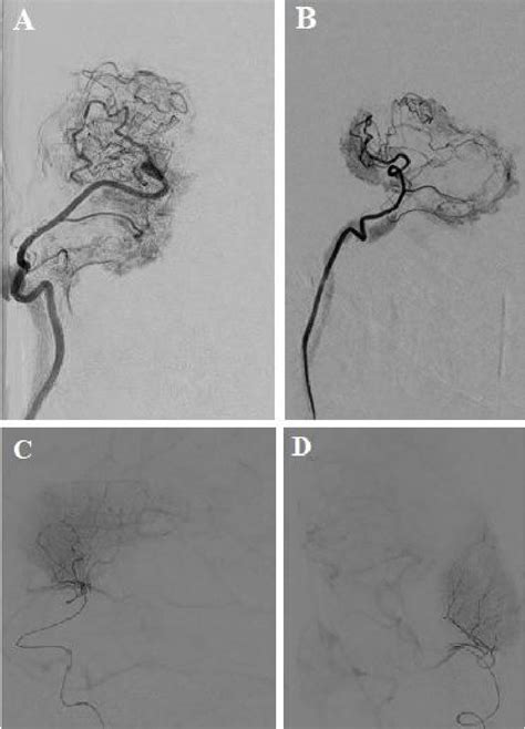 Figure 5 From Cranial Transposition And Revascularization Of Autologous