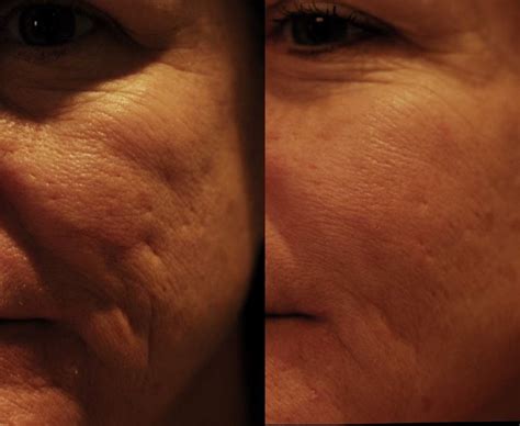 Laser Acne Treatments Cost Laser Scar Removal Cost