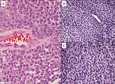 A In Cells Blocks Tumor Cells Were Arranged In Large Groups And Had