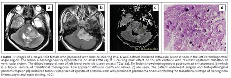 Differentiation Between Various Types And Subtypes Of Intracranial