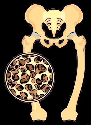 Osteomalacia Dott Ambrogio Peretti Roma