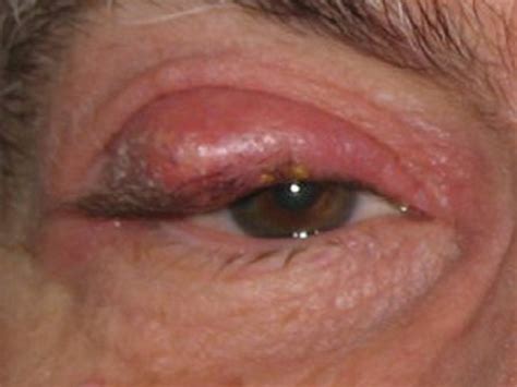 Chalazion Cyst Symptoms Pictures Causes And Treatment 55 Off