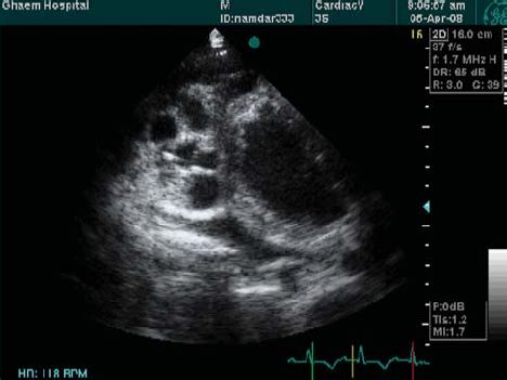 Echocardiographic Appearance Of Left Ventricular Hydatid Cysts In