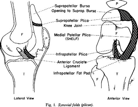 Figure 1 From Arthroscopy Of The Plicae—synovial Folds And Their