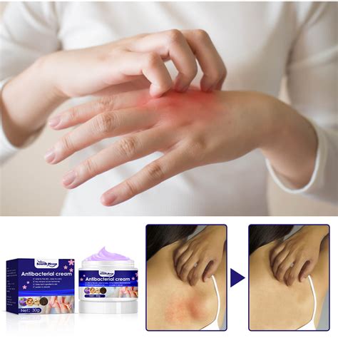 South Moon Viola Yedoensis Anti Itch Cream Relieves Skin Itching And Insect Bites Anti Itch