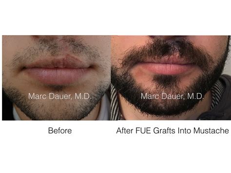 Facial Transplant Beard Hair Transplant Before And After Photos