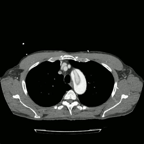 Chest Pathology Radiology Cafe