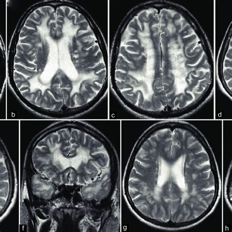 A Axial T1 Weighted Image Shows Periventricular Hypointensities B C Download Scientific