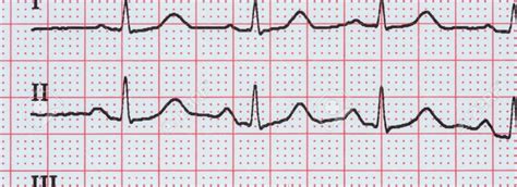 Électro cardiogramme ECG Cardiologie Intercard