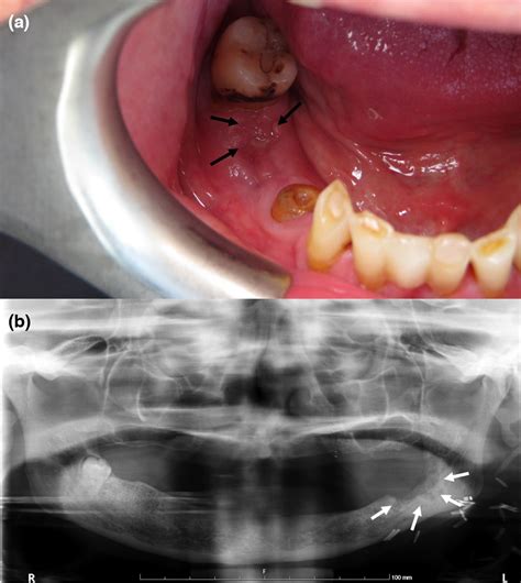 The Role Of Hyperbaric Oxygen In Osteoradionecrosis—a Prophylactic