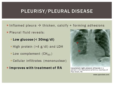 Pleurisy treatment antibiotics