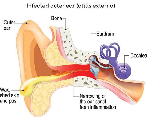 Parents Guide To Ear Infections