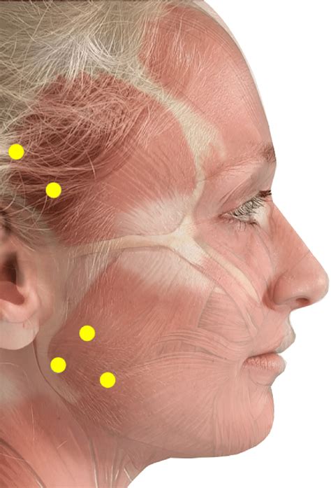 Masseter Botox Injection Sites