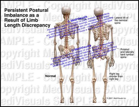 Persistent Postural Imbalance As A Result Of Limb Length Discrepancy