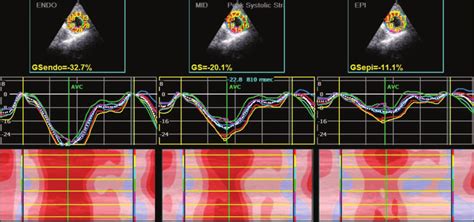 Left Ventricular Longitudinal Strain Curves Of Endocardium