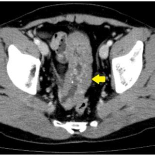 Preoperative Computed Tomography Ct Scan Contrast Enhanced Abdominal