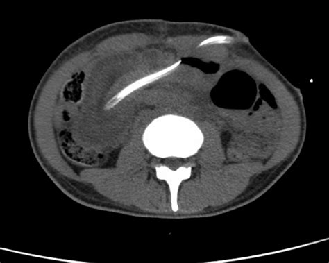 Jejuno Jejunal Intussusception An Unusual Complication Of Feeding Jejunostomy Bmj Case Reports