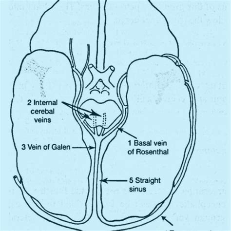 The Mechanism of Subdural Haemorrhage: The bridging veins travel from ...