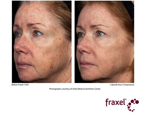 Fraxel Restore Aesthetics By Eileen Raleigh Nc