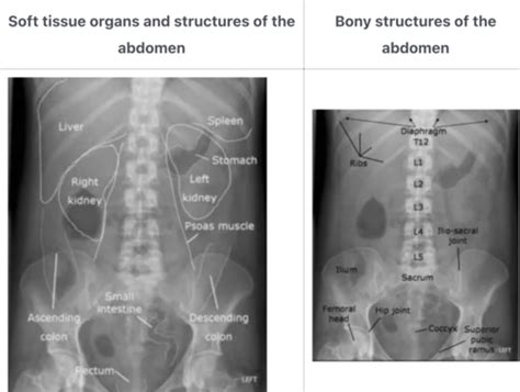 Abdomen And Ultrasounds Flashcards Quizlet