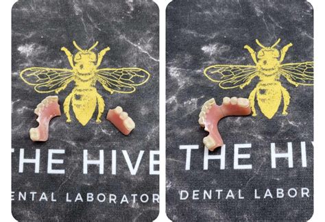 Can You Repair A Hole In Dentures The Hive Laboratory