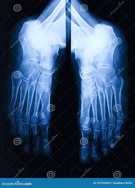 Foot Xray Showing Soft Tissue Gas In Patient With Necrotizing